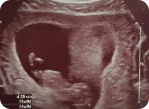 Zwanger en diabetes - eerste trimester